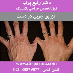 تزریق چربی در دست