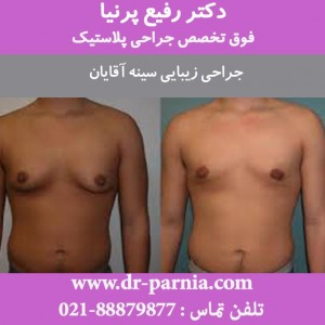 جراحی زیبایی سینه آقایان