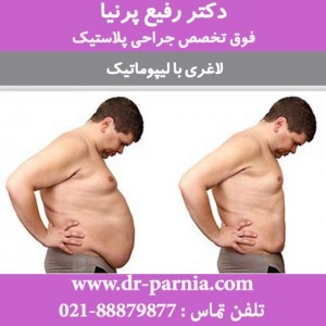 لیپوماتیک شکم