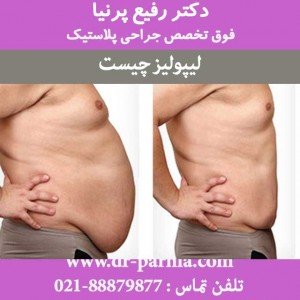 لیپولیز چیست