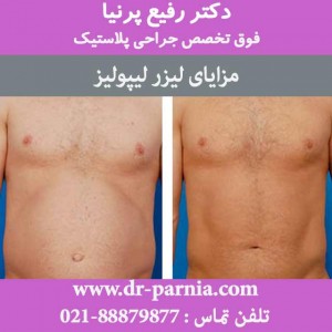 مزایای لیزر لیپولیز
