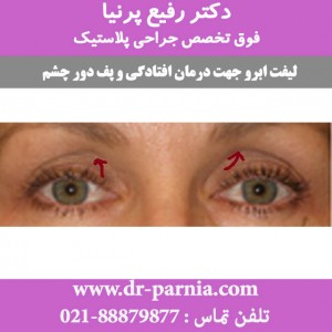 لیفت ابرو - 