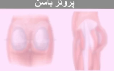 اقدامات بعد از جراحی باسن