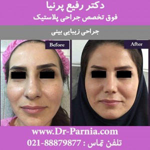 عمل بینی گوشتی