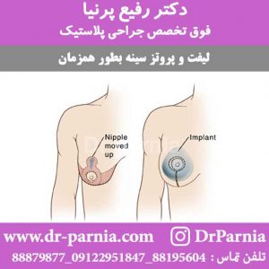 لیفت و پروتز سینه بطور همزمان