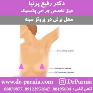محل برش پروتز سینه