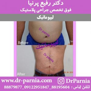 آمبولی بعد از لیپوماتیک