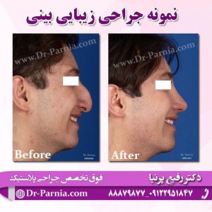 عکس قبل و بعد از جراحی بینی