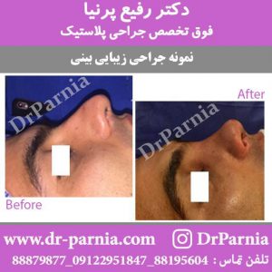 عکس قبل و بعد از جراحی بینی