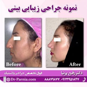 عمل زیبایی بینی