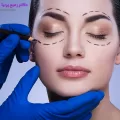 Blepharoplasty